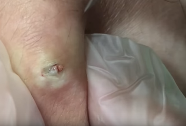 how to remove an epidermoid cyst at home