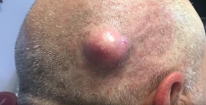 massive cystic acne popping massive cystic acne popping