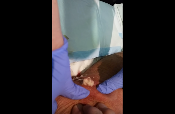 Huge Knee Infection | New Pimple Popping Videos