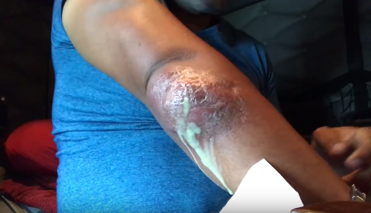 staph infection pus plug New Pimple Popping Videos