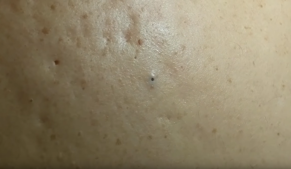 Removing Lots Of Blackheads From The Back New Pimple Popping Videos