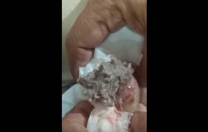 huge-cyst-on-the-leg-with-black-pus-new-pimple-popping-videos