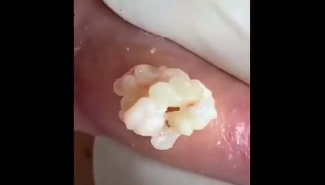 sebaceous-cyst-with-white-pus-drained-new-pimple-popping-videos-my