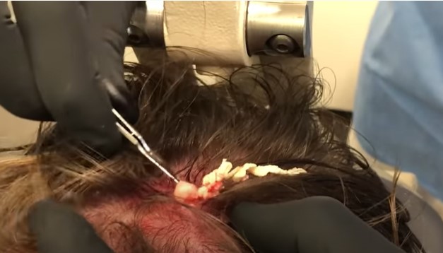 Eruptive Pilar Cyst On Scalp New Pimple Popping Videos