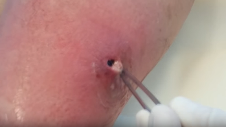 popping staph infection videos | New Pimple Popping Videos