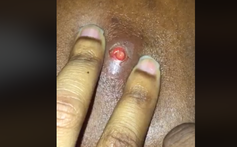 Infected Ingrown Hair Pimple Popped New Pimple Popping Videos