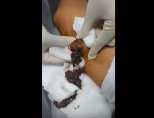 cyst with black dot in the middle | New Pimple Popping Videos