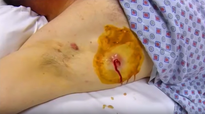 Incision And Drainage Of A Deep Neck Abscess New Pimple Popping Videos