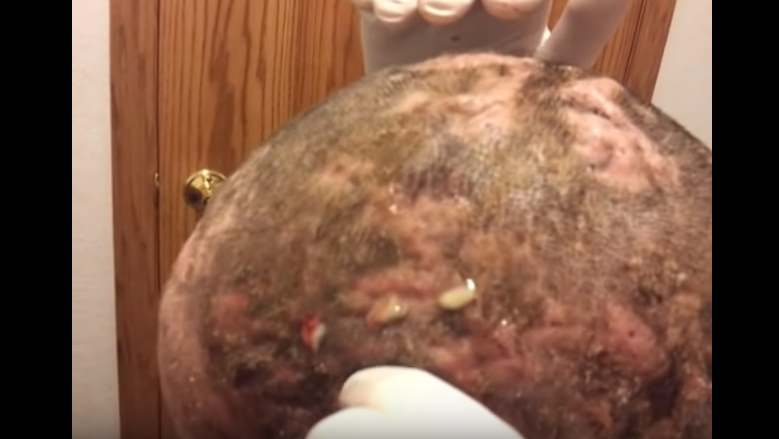 cystic acne on scalp. | New Pimple Popping Videos