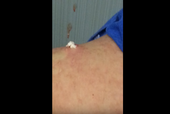 Exploding Cyst Popping with Blood and Chunks | New Pimple Popping Videos