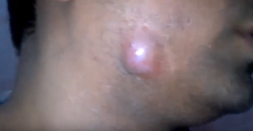 Ingrown Hair Cysts