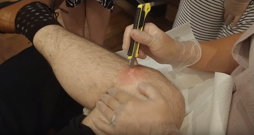 armpit cyst removal at home