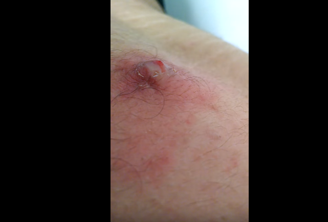Popping Ingrown Hair Infection On The Back New Pimple Popping Videos