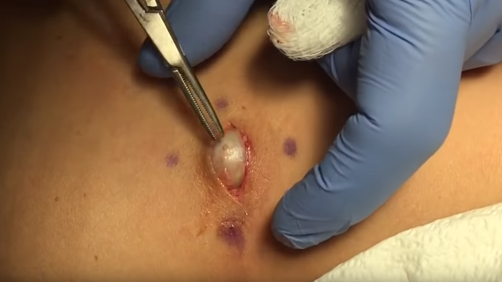 Clean Removal Of a Cyst