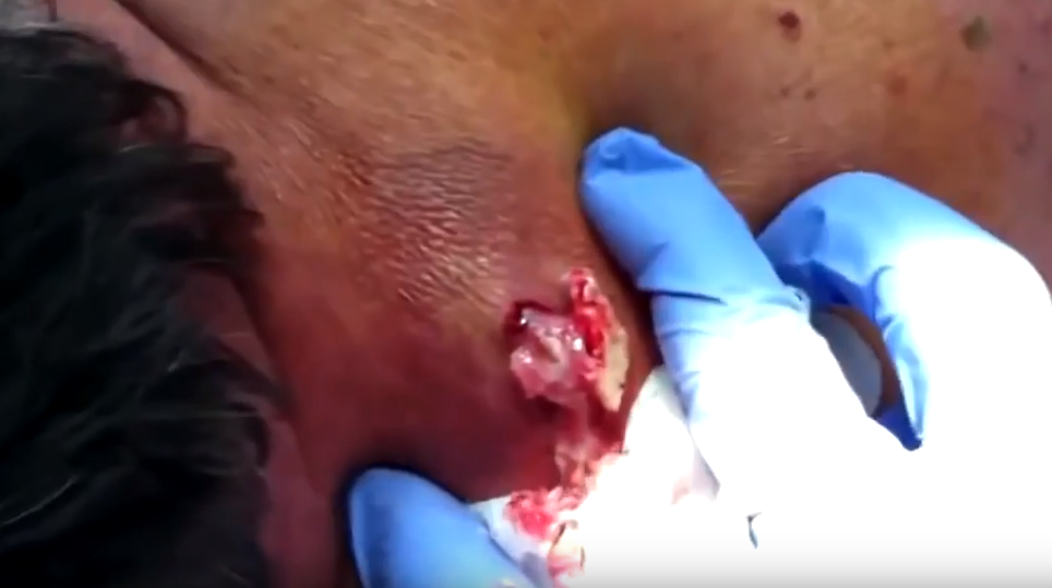 Popping Huge Neck Cyst