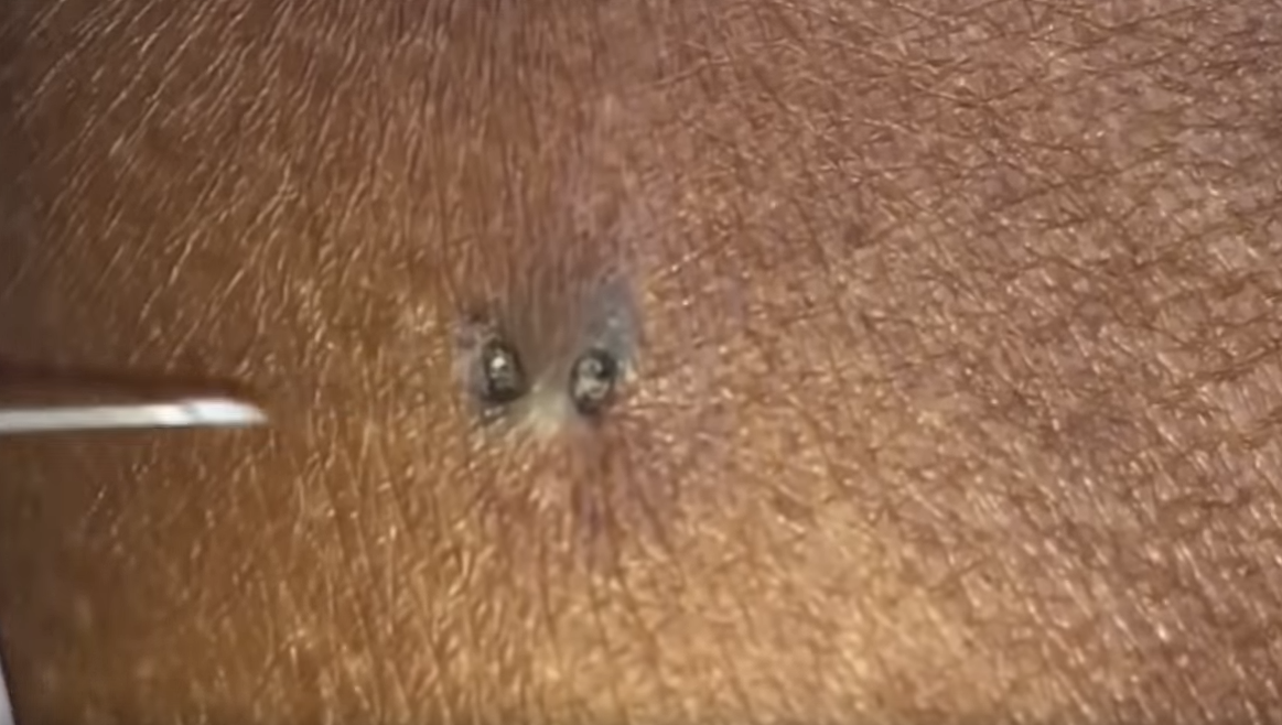 Hard To Remove Double Blackheads | New Pimple Popping Videos