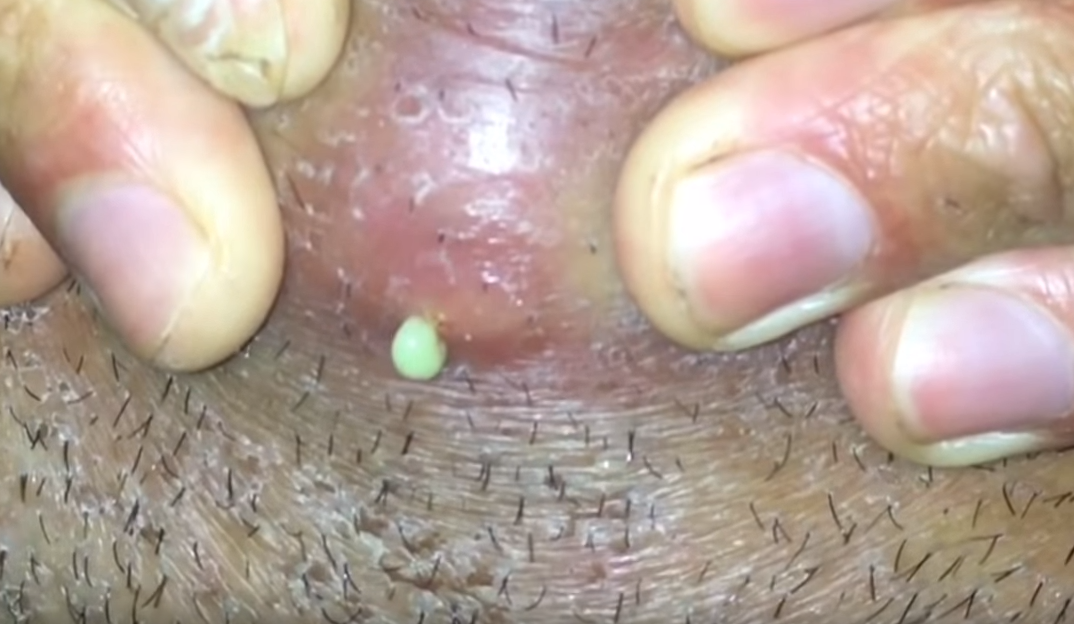 Ingrown Hair Turned Into Hard Lump Under Skin New Pimple Popping Videos