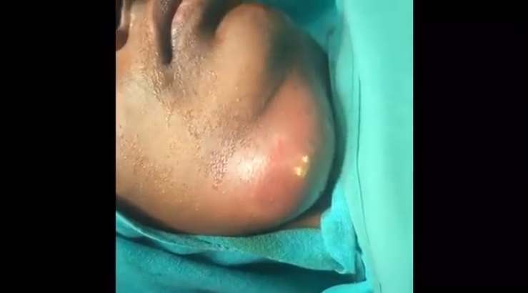 infection in neck and jaw. head and neck infections | New ...