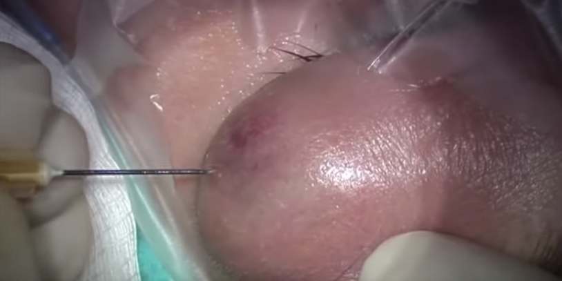 Juicy Eyelid Abscess Drainage - New Pimple Popping Videos.