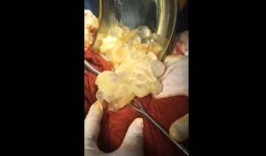 cyst hydatid pimple