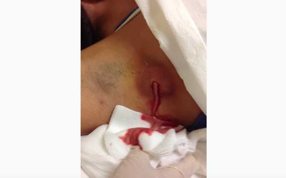 Huge Armpit Abscess Drainage - New Pimple Popping Videos.