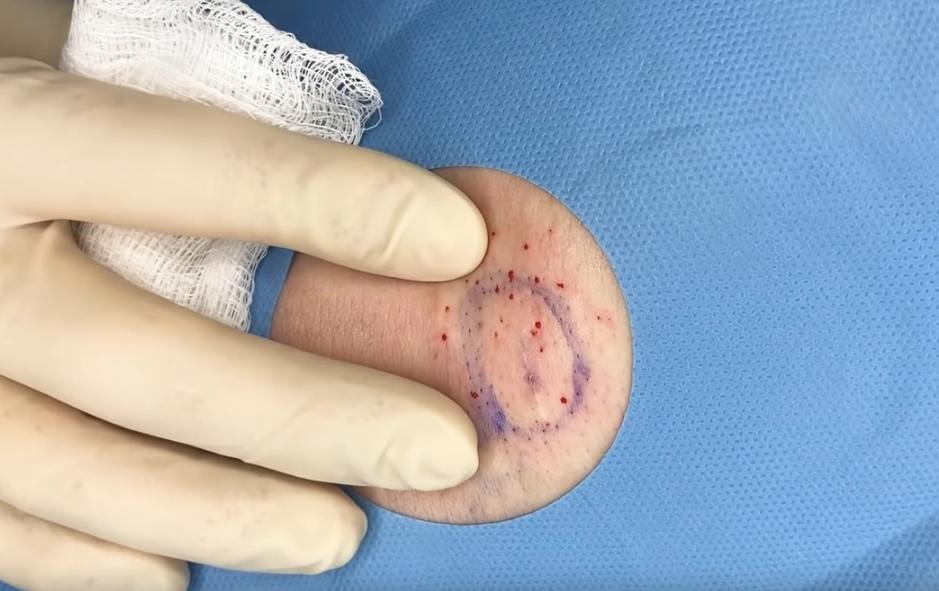 Deep Cyst Sack Removal New Pimple Popping Videos