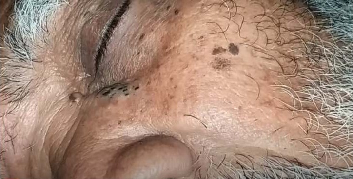 Blackheads On Lips New Pimple Popping Videos