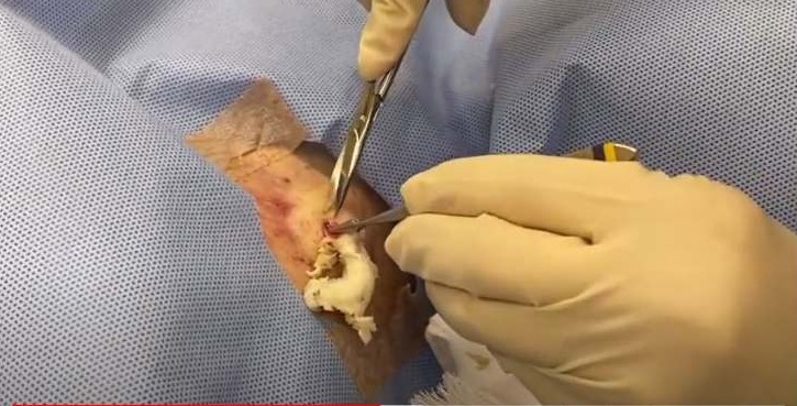 epidermoid cyst removal video New Pimple Popping Videos