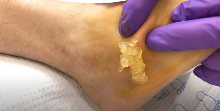 Ganglion Cyst On The Foot Drained New Pimple Popping Videos