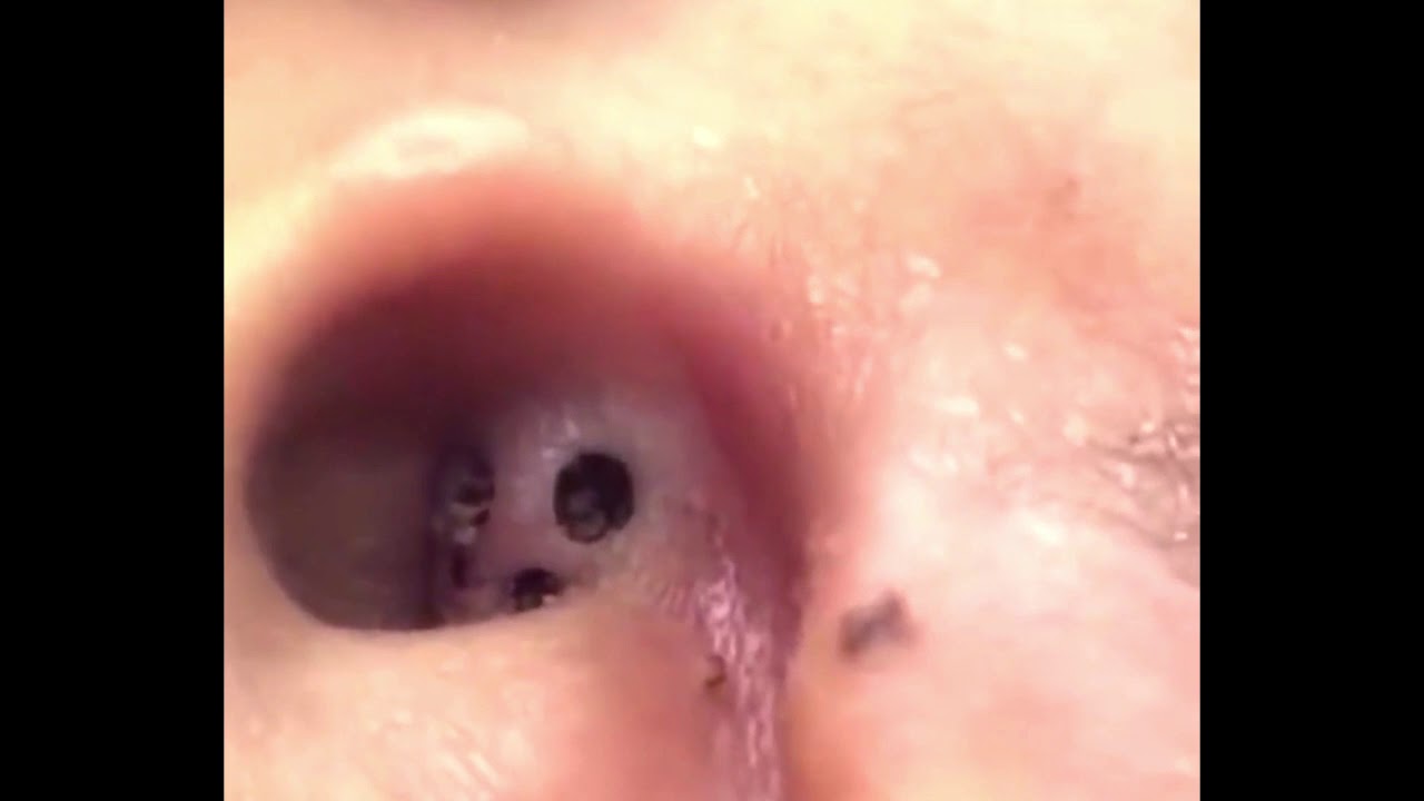 Nasty Ear blackheads | New Pimple Popping Videos