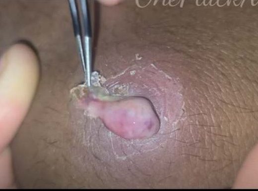 Ingrown pubic hair cyst Archives - New Pimple Popping Videos