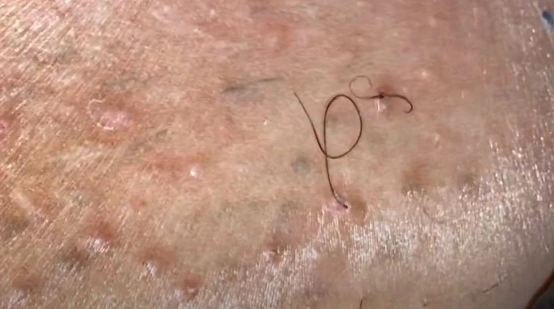 When a person has an ingrown hair they look like bumps on their skin that r...