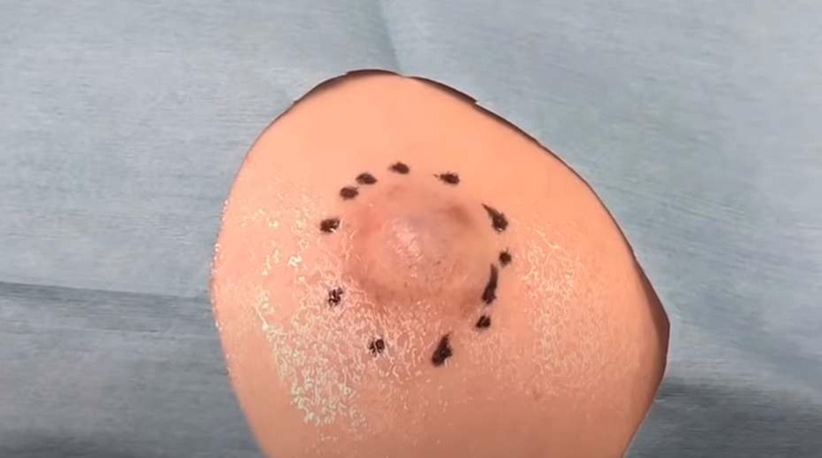 Perchè Mi Piace Vedere Spremere I Brufoli
