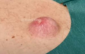 massive cystic acne popping