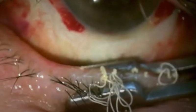 Meibomian (eyelid) Gland Expression