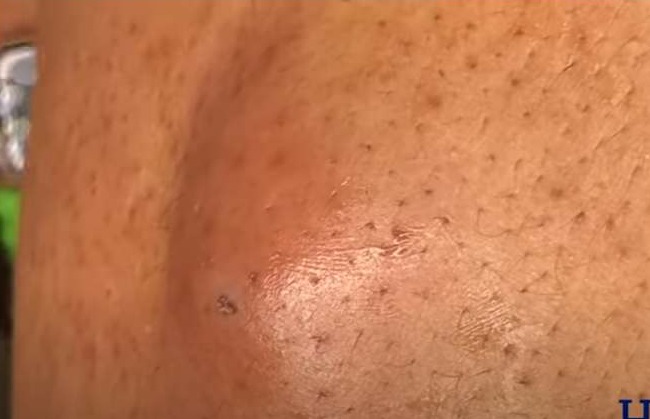 massive cystic acne popping