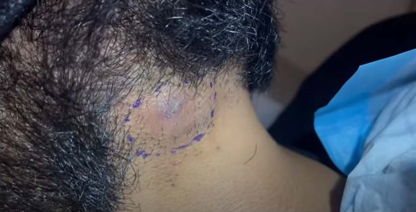 Ingrown Hair Cyst On Beard Popped - New Pimple Popping Videos