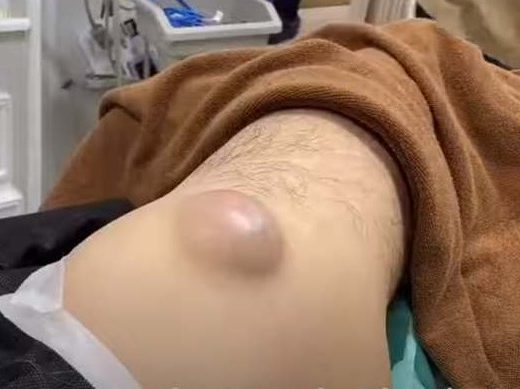 lump on inner thigh under skin Archives - New Pimple Popping Videos