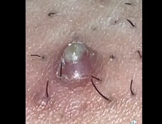 Ingrown pubic hair cyst Archives - New Pimple Popping Videos