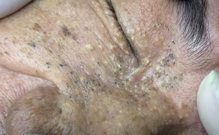 blackheads-goldmine-around-eyes-new-pimple-popping-videos