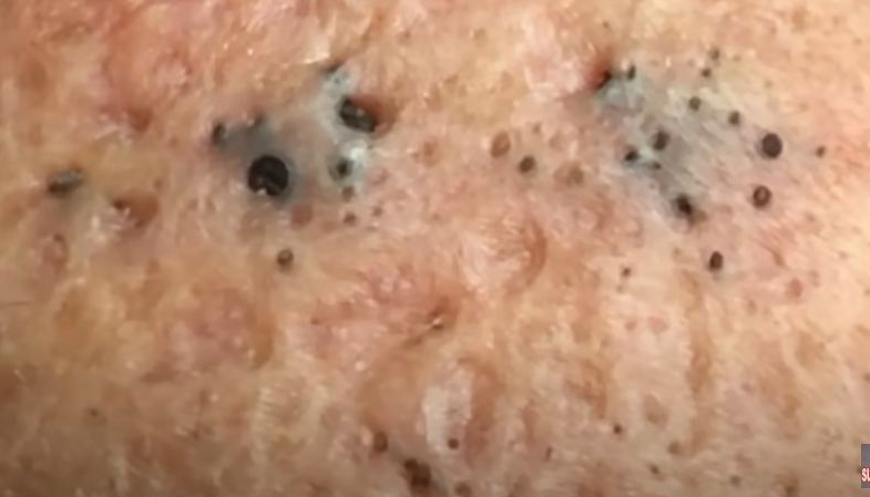 blackheads-the-best-and-worst-ways-to-remove-them