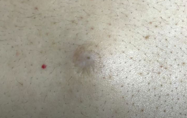 Big Epidermal Cyst Removal New Pimple Popping Videos